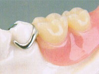 C1：歯の表面（エナメル質）の虫歯:術前画像