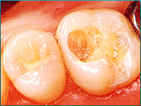 C1：歯の表面（エナメル質）の虫歯:術前画像