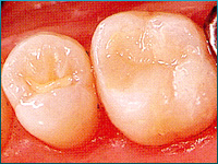 C1：歯の表面（エナメル質）の虫歯:術後画像