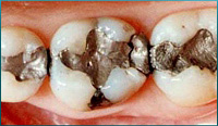 C2：歯の中（象牙質）の虫歯